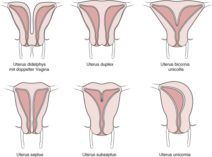 Uterus Didelphys Porn